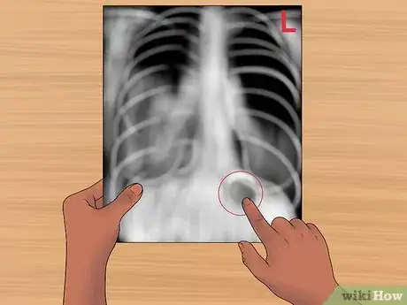 Immagine titolata Read a Chest X Ray Step 11