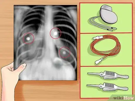 Immagine titolata Read a Chest X Ray Step 13