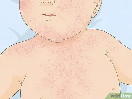 Immagine titolata Treat Baby Heat Rash Step 7