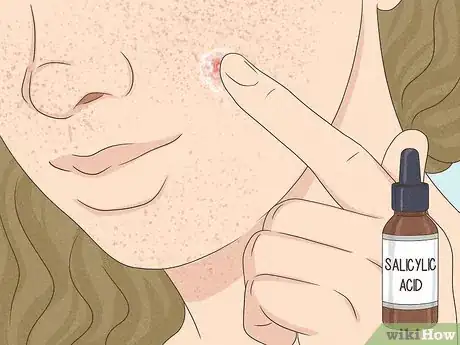 Immagine titolata Get Rid of a Zit Overnight Step 3