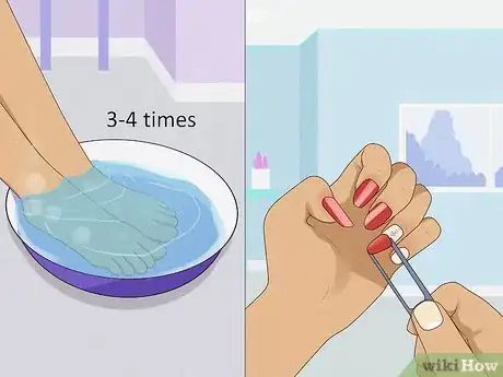 Immagine titolata Stop Itchy Cuticles Step 5