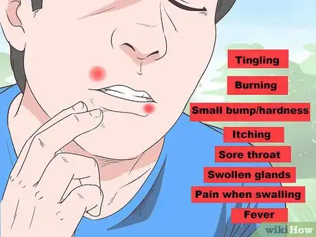 Immagine titolata Treat a Cold Sore or Fever Blisters Step 2