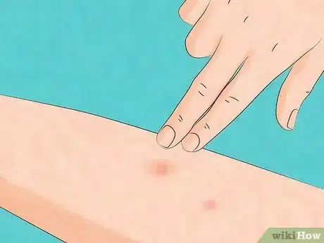 Immagine titolata Stop Bed Bug Bites Immediately Step 14