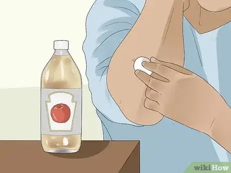 Immagine titolata Get Rid of Skin Tags Step 13