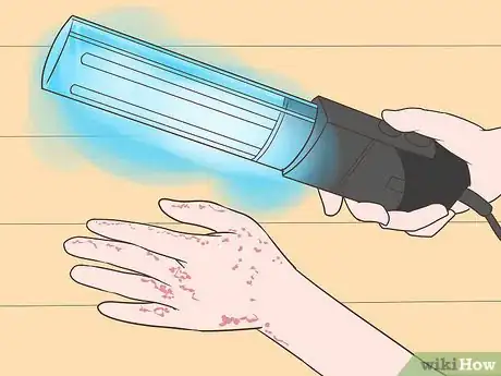 Immagine titolata Treat Hand Eczema Step 13