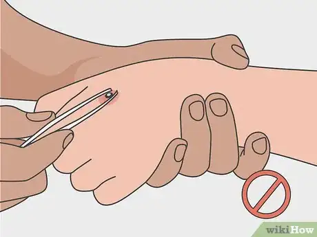 Immagine titolata Treat a Puncture Wound Step 10