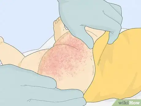Immagine titolata Treat Baby Heat Rash Step 10
