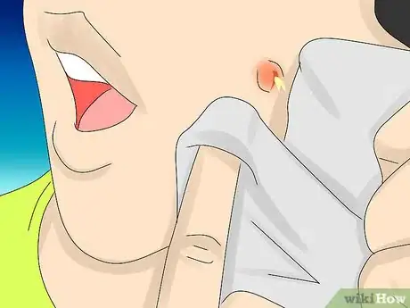 Immagine titolata Painlessly Pop a Pimple Step 8