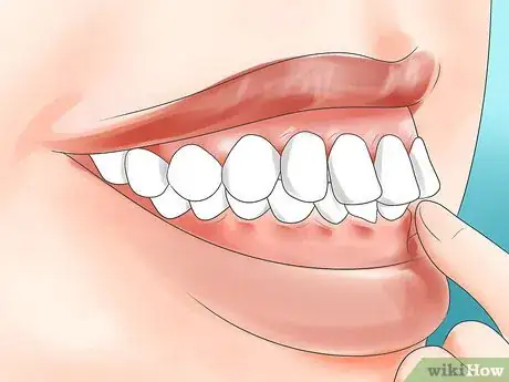 Immagine titolata Determine if You Need Braces Step 4