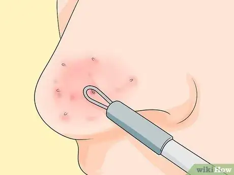 Immagine titolata Prevent Blackheads Step 10