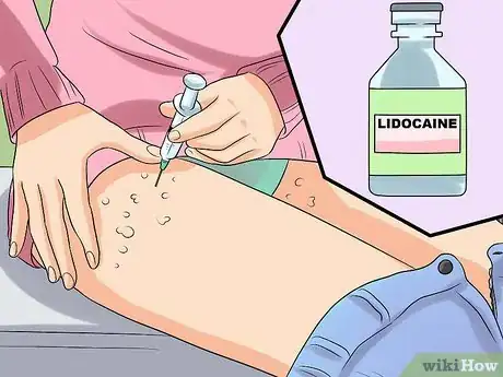 Immagine titolata Ease Herpes Pain with Home Remedies Step 21