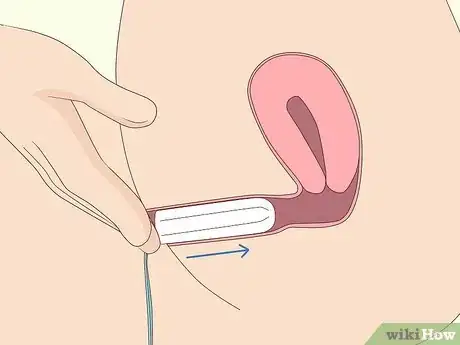 Immagine titolata Insert a Tampon Without Applicator Step 7