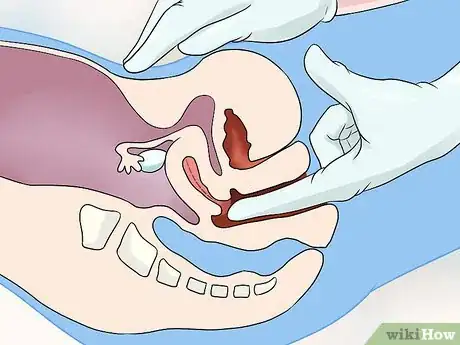 Immagine titolata Diagnose Uterine Fibroids Step 5