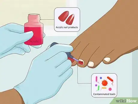 Immagine titolata Stop Itchy Cuticles Step 3