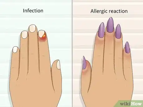 Immagine titolata Stop Itchy Cuticles Step 4