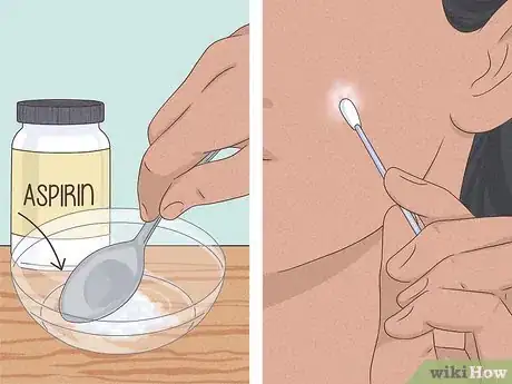 Immagine titolata Get Rid of a Zit Overnight Step 5