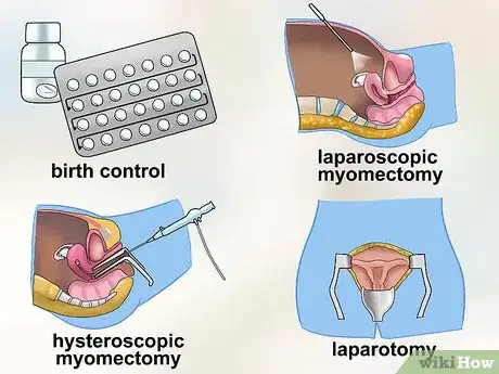 Immagine titolata Diagnose Uterine Fibroids Step 7