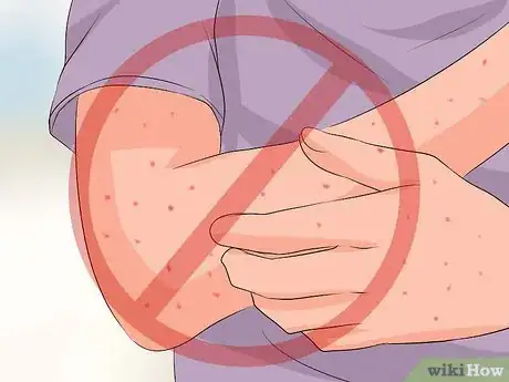 Immagine titolata Recognize Chickenpox Step 11