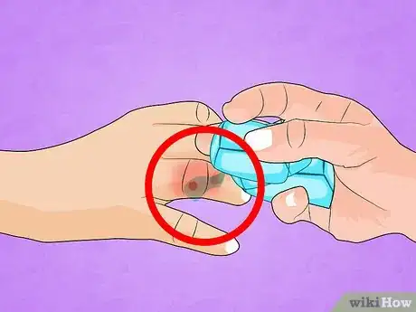 Immagine titolata Treat a Broken Finger Step 5