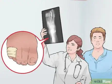 Immagine titolata Tape a Broken Pinky Toe Step 1