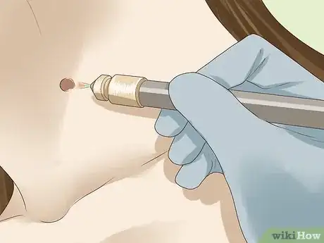 Immagine titolata Get Rid of Skin Tags Step 4