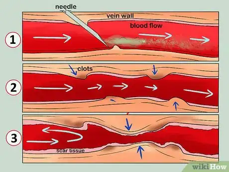 Immagine titolata Know when Your Vein Has Collapsed Step 4