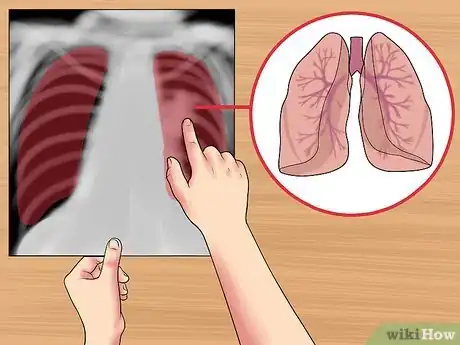 Immagine titolata Read a Chest X Ray Step 19