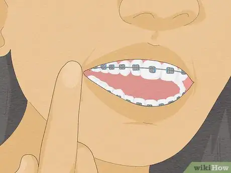 Immagine titolata Temporarily Fix a Loose Wire on Your Braces Step 1