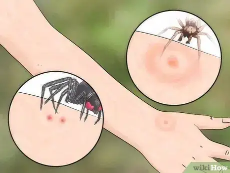 Immagine titolata Identify Insect Bites Step 7