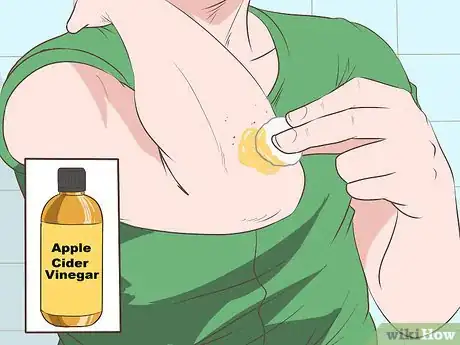 Immagine titolata Stop Mosquito Bites from Itching Step 5