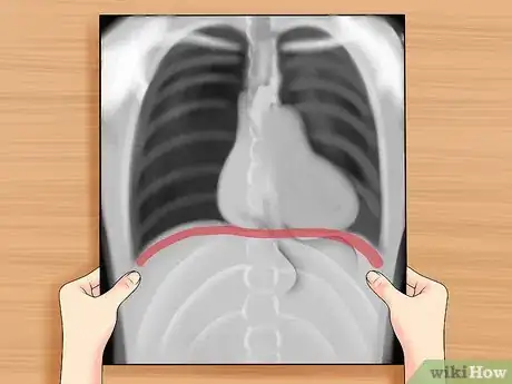 Immagine titolata Read a Chest X Ray Step 17