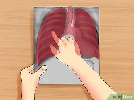 Immagine titolata Read a Chest X Ray Step 14