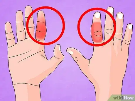 Immagine titolata Treat a Broken Finger Step 1