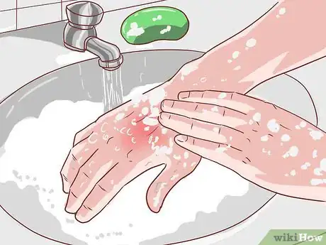 Immagine titolata Handle an Eczema Flare Up Step 15