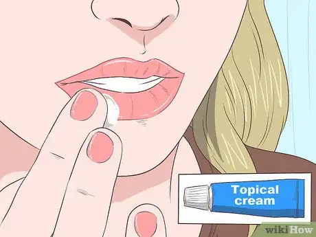 Immagine titolata Treat a Cold Sore or Fever Blisters Step 24