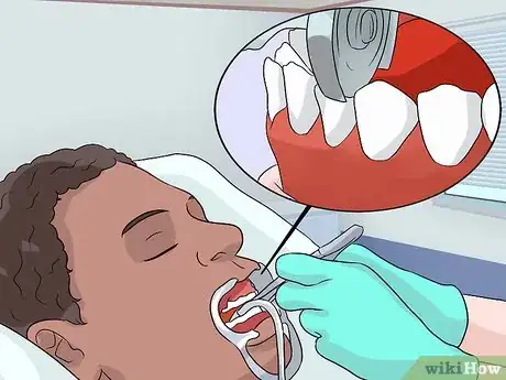 Immagine titolata Stop a Mouth Ulcer from Hurting Step 23