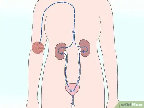 Immagine titolata Bring Down High Creatinine Levels Step 1