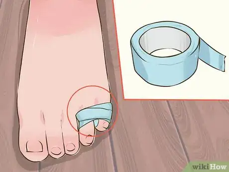 Immagine titolata Tape a Broken Pinky Toe Step 4