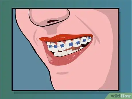 Immagine titolata Deal with Braces Step 17