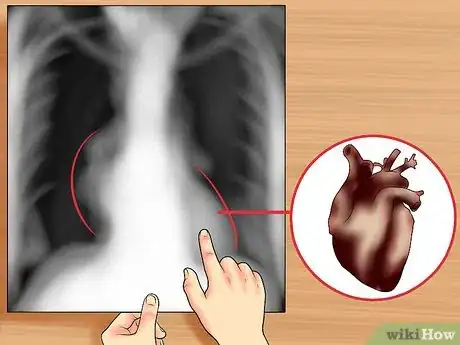 Immagine titolata Read a Chest X Ray Step 18