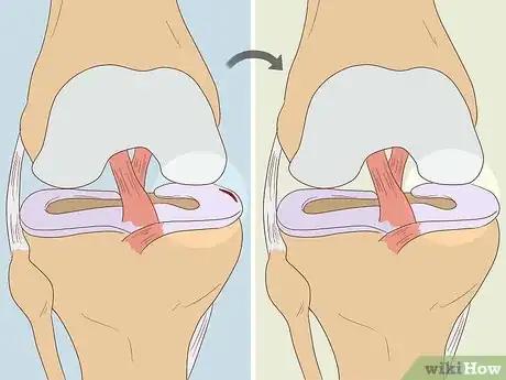 Immagine titolata Heal a Meniscus Tear Step 5