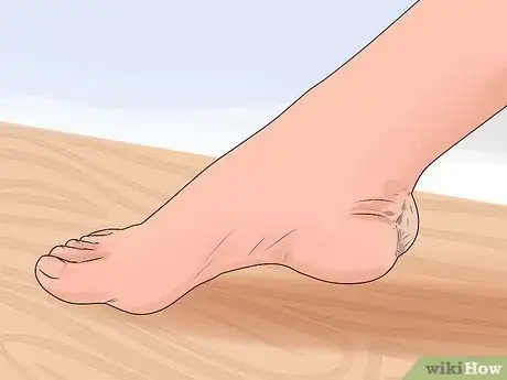 Immagine titolata Care for a Burst Blister Step 3
