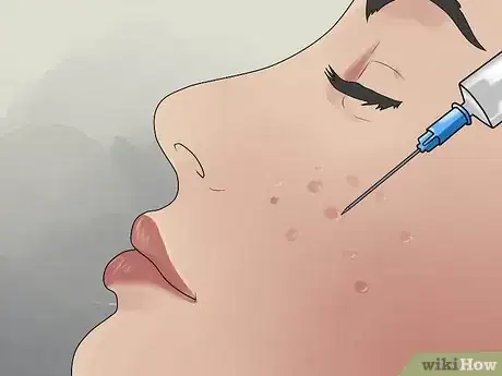 Immagine titolata Get Rid of Cystic Acne Scars Step 10