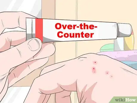 Immagine titolata Stop Mosquito Bites from Itching Step 7