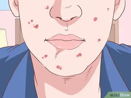 Immagine titolata Recognize the Signs of Meth Abuse Step 6