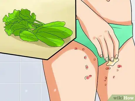 Immagine titolata Ease Herpes Pain with Home Remedies Step 15