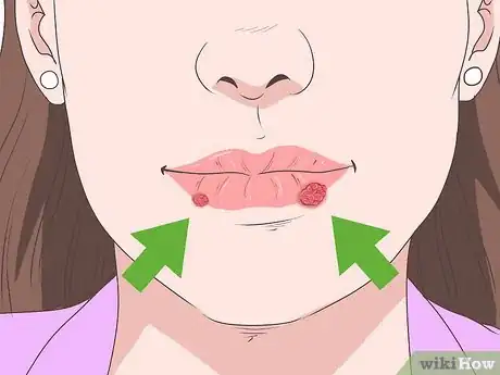 Immagine titolata Treat a Cold Sore or Fever Blisters Step 1