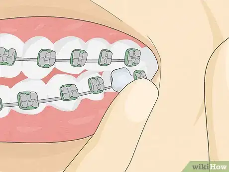 Immagine titolata Temporarily Fix a Loose Wire on Your Braces Step 7