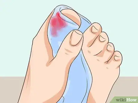 Immagine titolata Treat a Torn Toenail Step 2