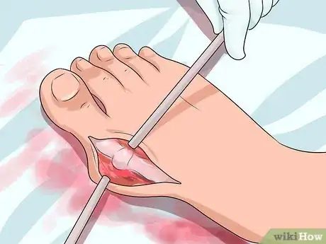 Immagine titolata Get Rid of Bunions Step 11